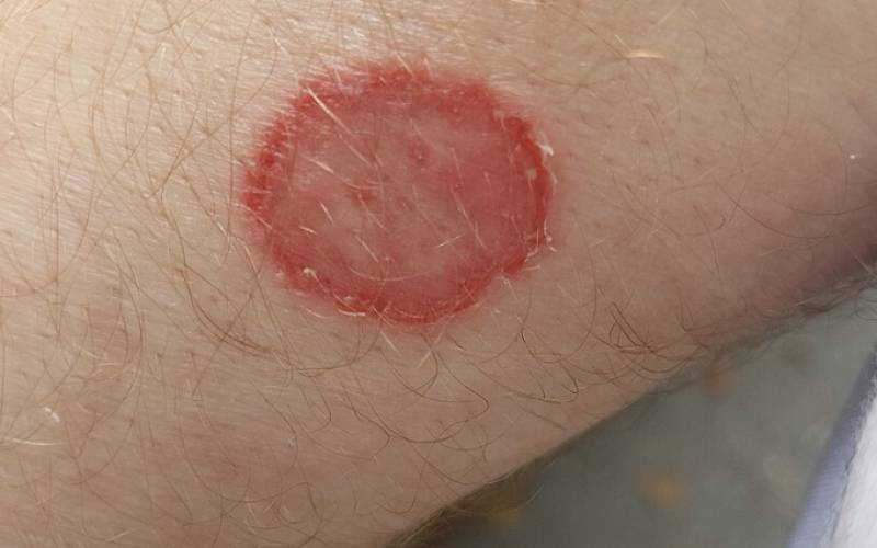 Ringworm scare ruins Brit's Canary Islands cruise